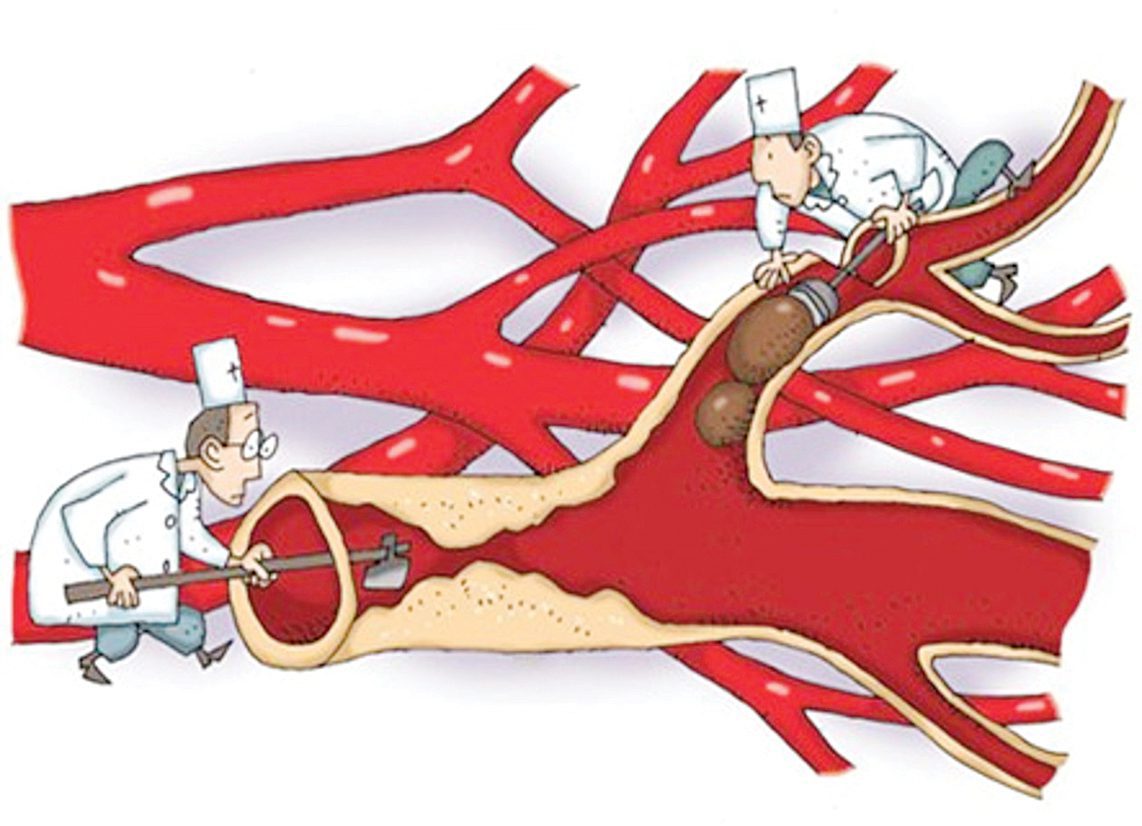 Tai biến mạch máu não (đột quỵ não) 2 TacMach