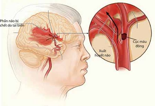 Tai biến mạch máu não (đột quỵ não) 3 XuatHuyetNao