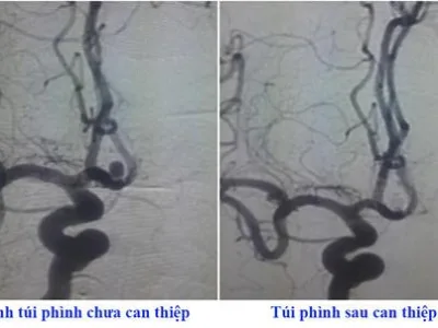 Người đàn ông Đột quỵ do không duy trì thuốc huyết áp 10 ha