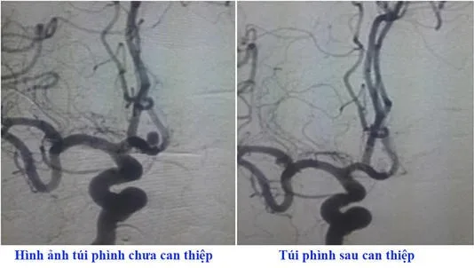 Người đàn ông Đột quỵ do không duy trì thuốc huyết áp 1 ha jpg