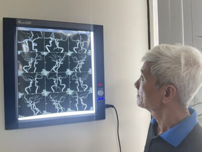Giải nguy 1 bệnh nhân sắp bị đột quỵ não 1 dot quy nao 1