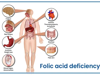 tác dụng dự phòng đột quỵ não nguyên phát của Acid Folic. Phân tích gộp 2024 11 folic acid deficiency