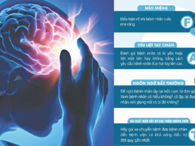 Sản phẩm phòng ngừa đột quỵ: 1 Giải pháp mới được thế giới nghiên cứu trong việc dự phòng đột quỵ 10 Noi dung